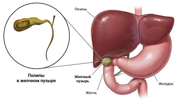 Народное лечение полипа в желчном пузыре. Полипоз желчного пузыря. Полип на желчном пузыре желчный. Желчь полипы в желчном пузыре.