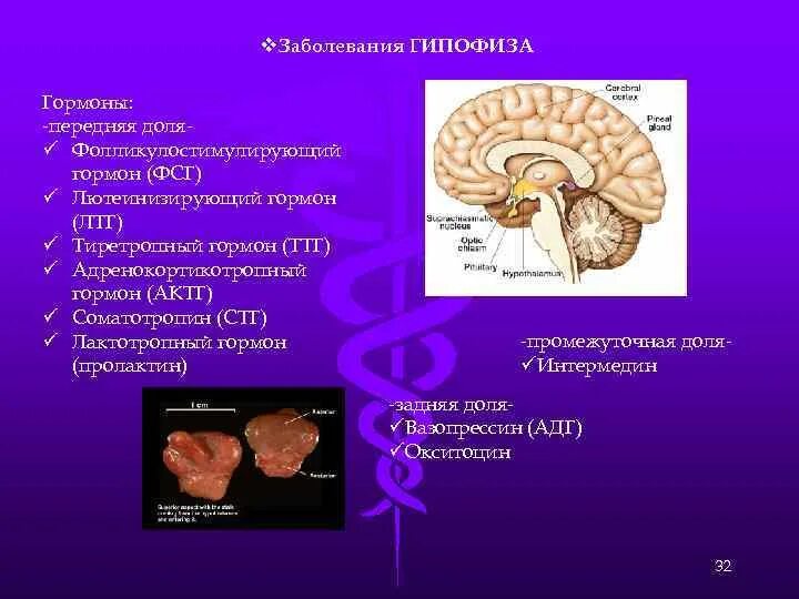 Гипофиз последствия. Гормонопродуцирующая аденома гипофиза. Болезни с нарушением деятельности гипофиза. Гипофиз гормоны и заболевания. Болезни гормонов гипофиза.