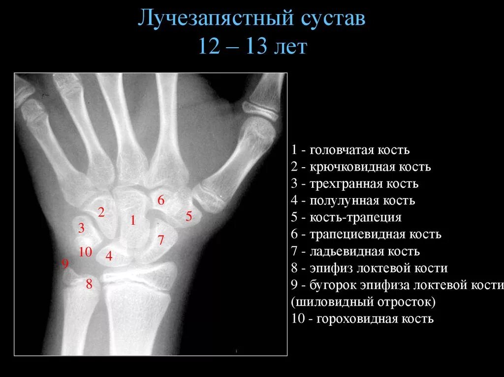 Запястье (анатомия) Радиография