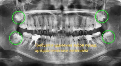 Расшифровка снимка