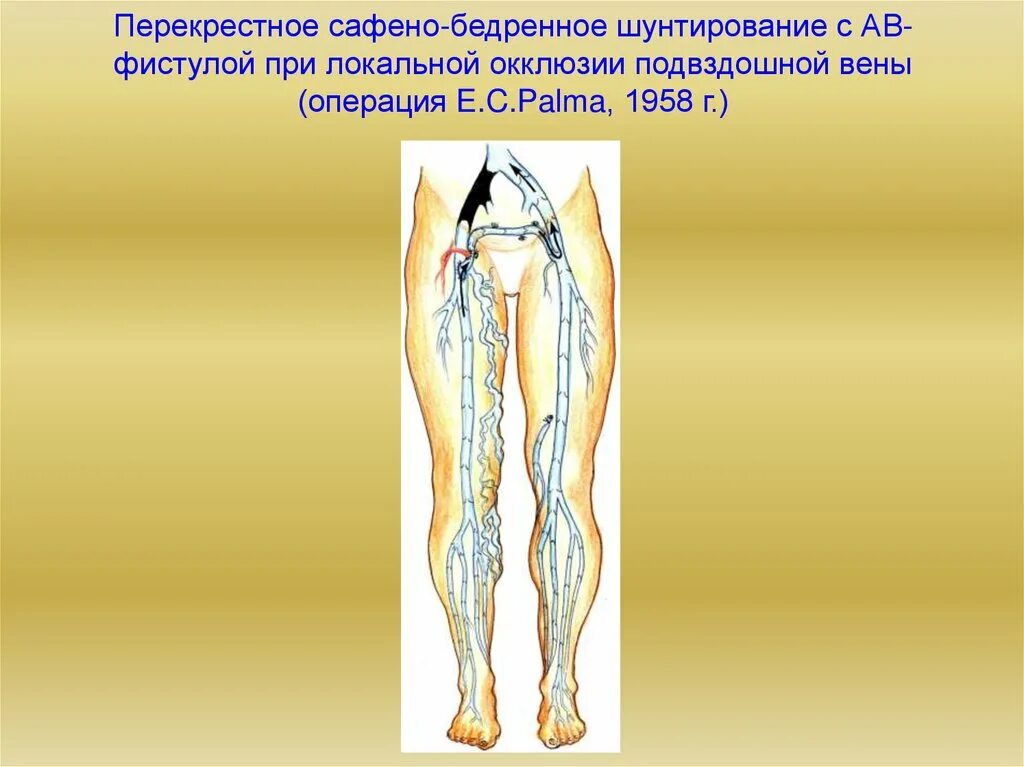 Состояние после бедренно. Тромбоз наружной подвздошной вены. перекрестное бедренно бедренное шунтирование.