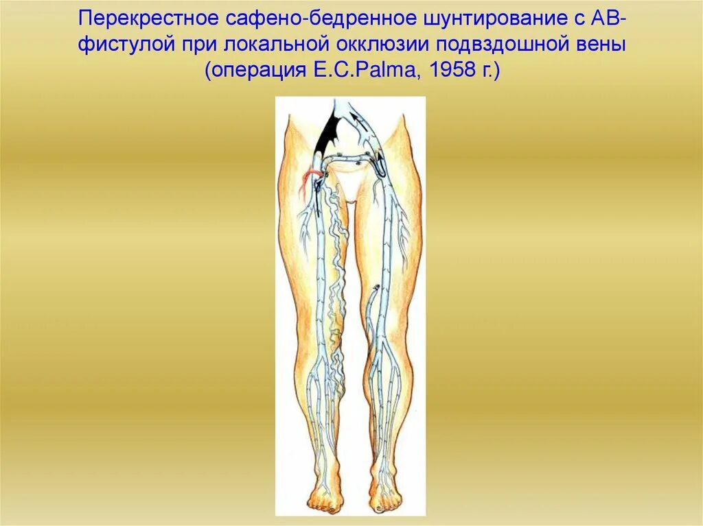 Тромбоз наружной подвздошной вены. Перекрестное бедренно бедренное шунтирование. Перекрестное подвздошно бедренное шунтирование. Бедренно-подколенное шунтирование. Тромбоз подвздошной вены