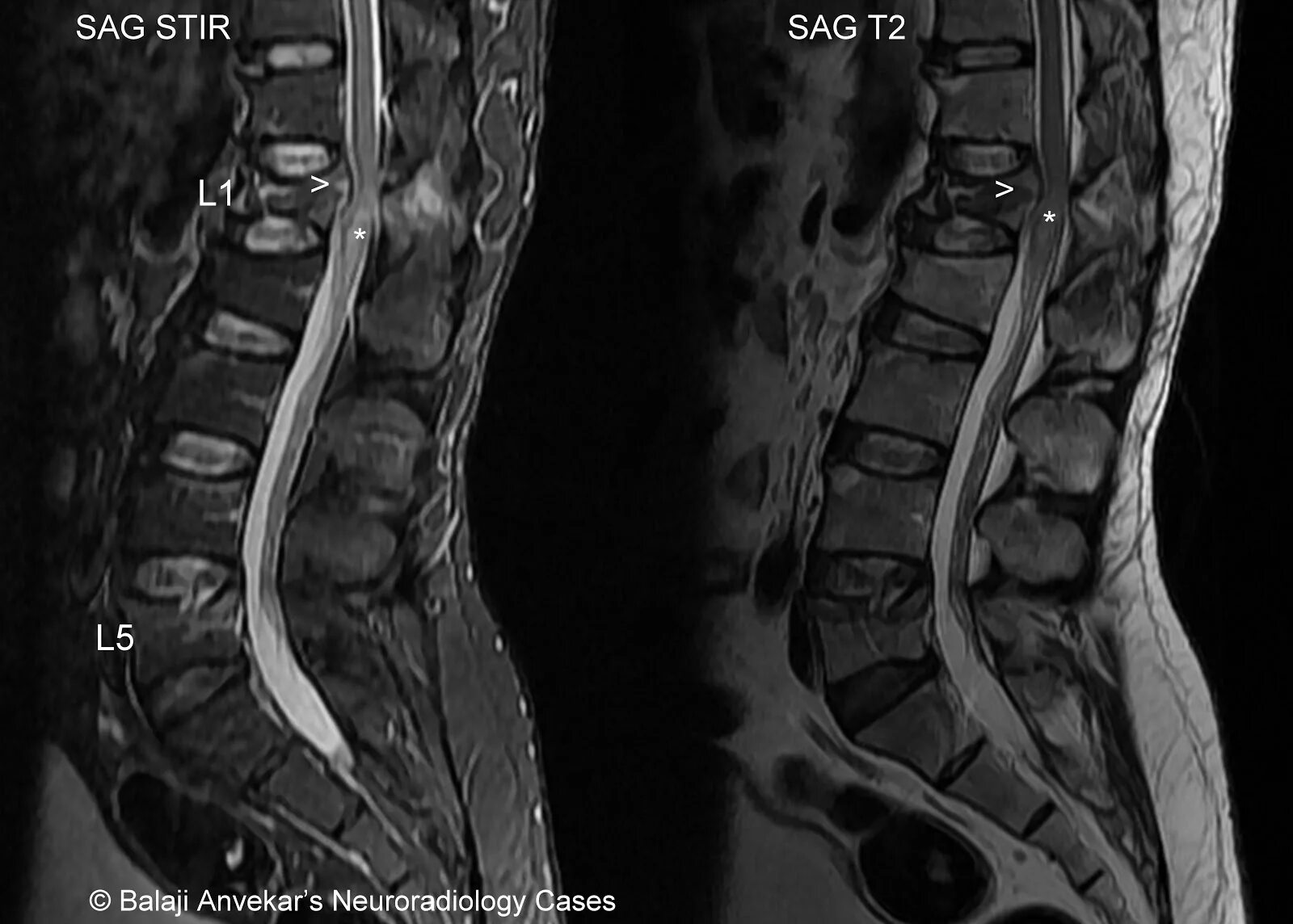 Spine mri. Lumbar spine fracture mri radiology. diastomielia spinal cord cervical mri.
