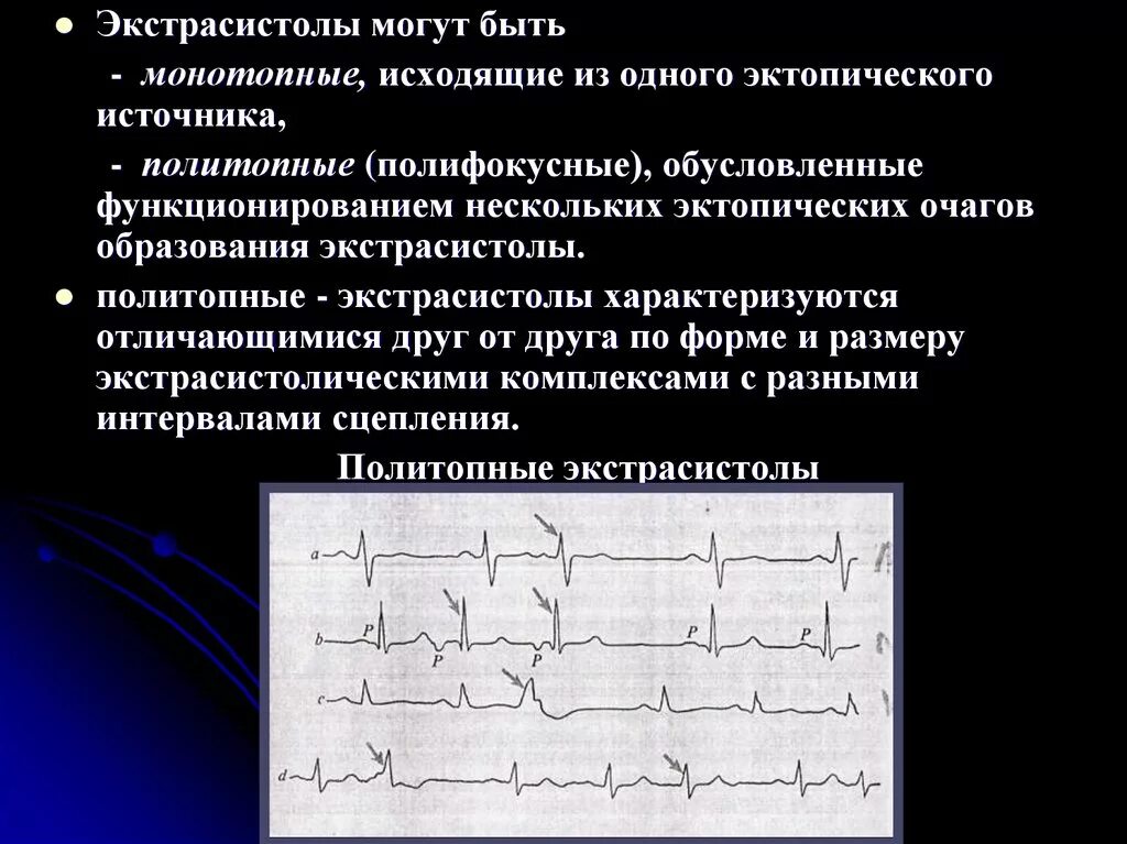 Экстрасистолы много