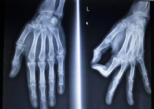 Как выглядит здоровая рука Forearm fracture, X-ray Stock Video Clip K005/1267 Science Photo Library