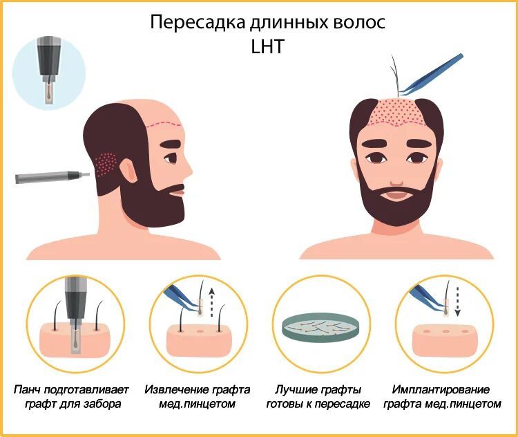 Пересадка волос 2023. Пересадка длинных волос. Методы пересадки волос. Лоскутный метод пересадки волос.