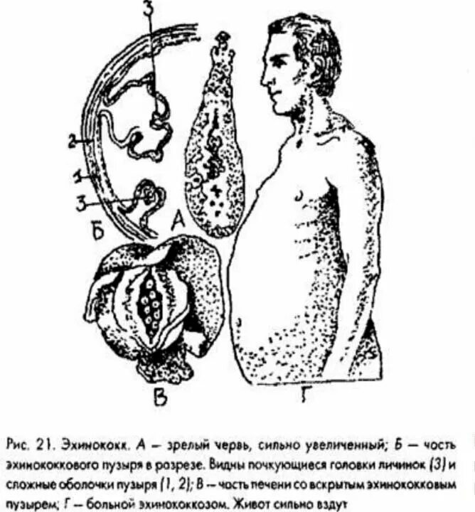 Эхинококки симптомы у людей лечение. Клинические проявления эхинококкоза. Эхинококкоз альвеококкоз симптомы. Эхинококк промежуточный хозяин. Эхинококкоз клинические симптомы.