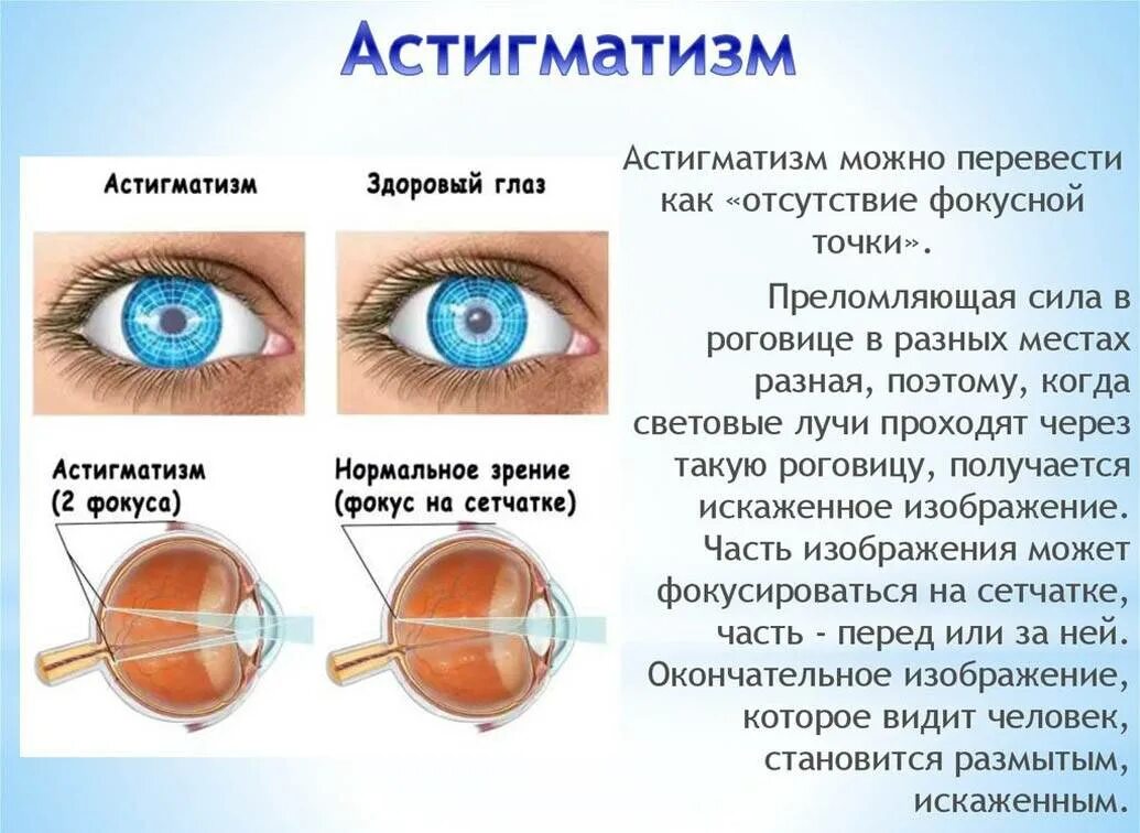 Значения слова зрение. Смешанный гиперметропический астигматизм. Строение глаза астигматизм. Гиперметропический астигматизм у детей. Сложный гиперметропический астигматизм.