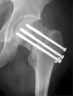 Neck fx