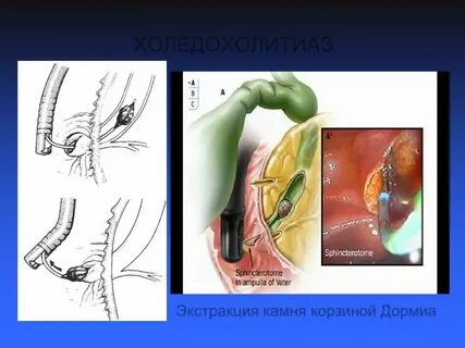 Литоэкстракция это