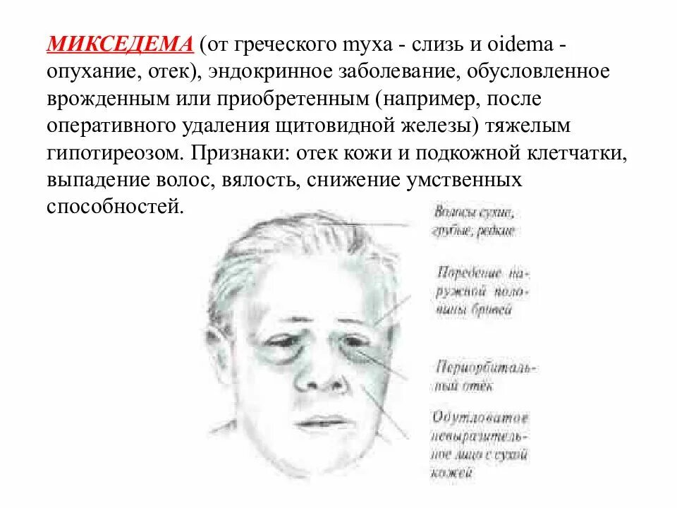 Гормональные отеки. Микседема (подкожный отек).. микседема гормональные препараты.