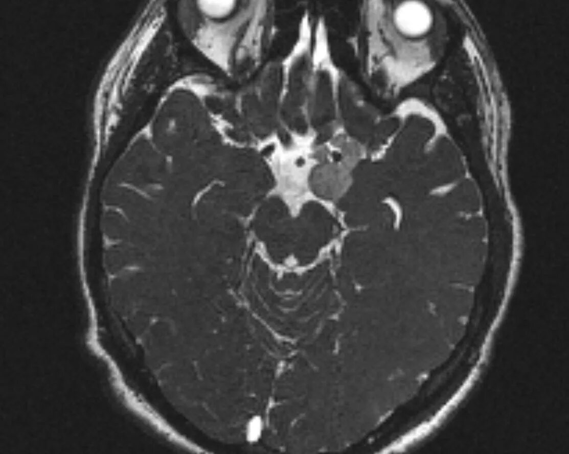 Киста головного мозга причины. Супраселлярная арахноидальная киста мрт. Арахноидальная киста гипофиза мрт. Ретроцеребеллярная арахноидальная киста кт. Супраселлярная цистерна на кт.