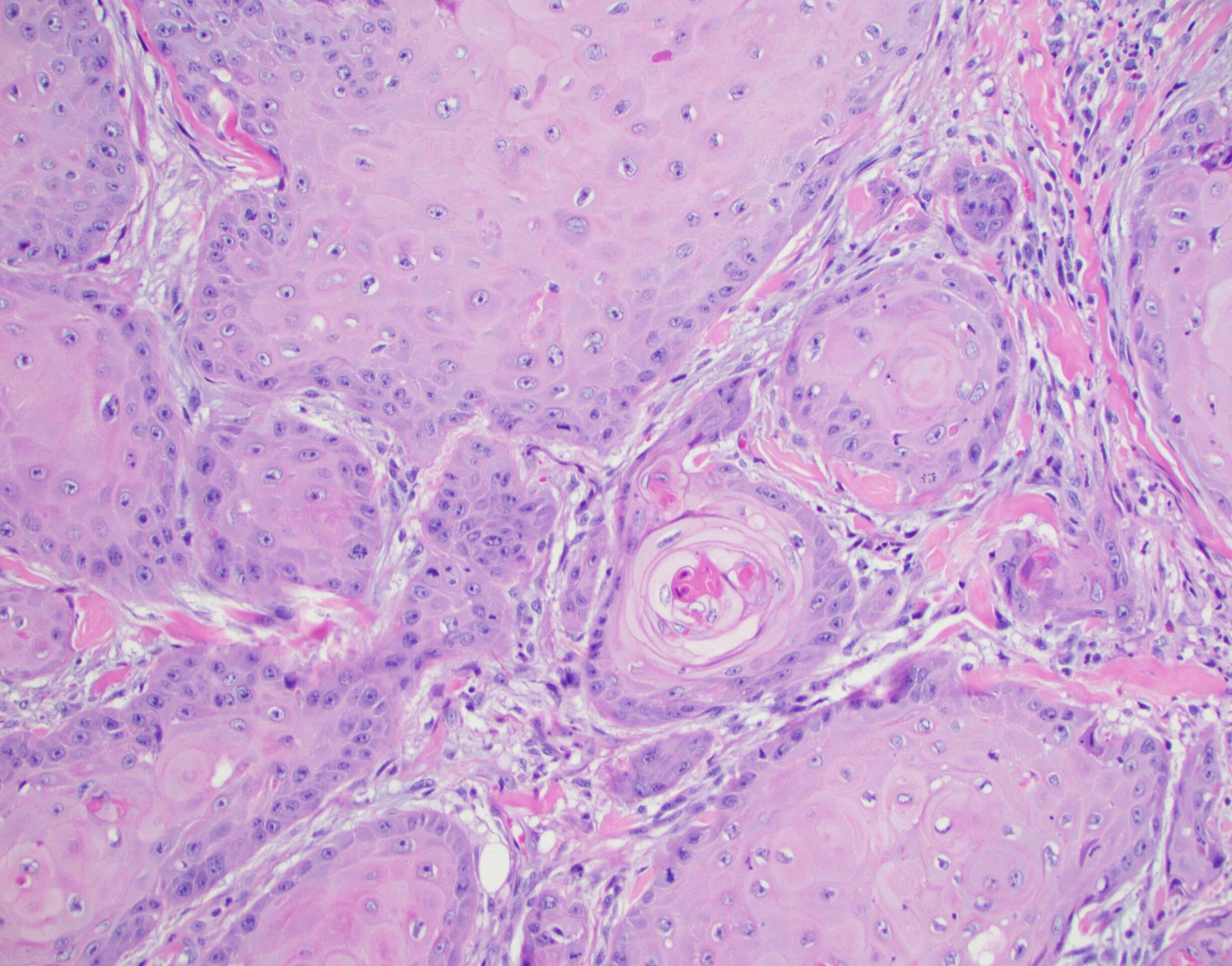 Vulvar Cancer Radiology Key
