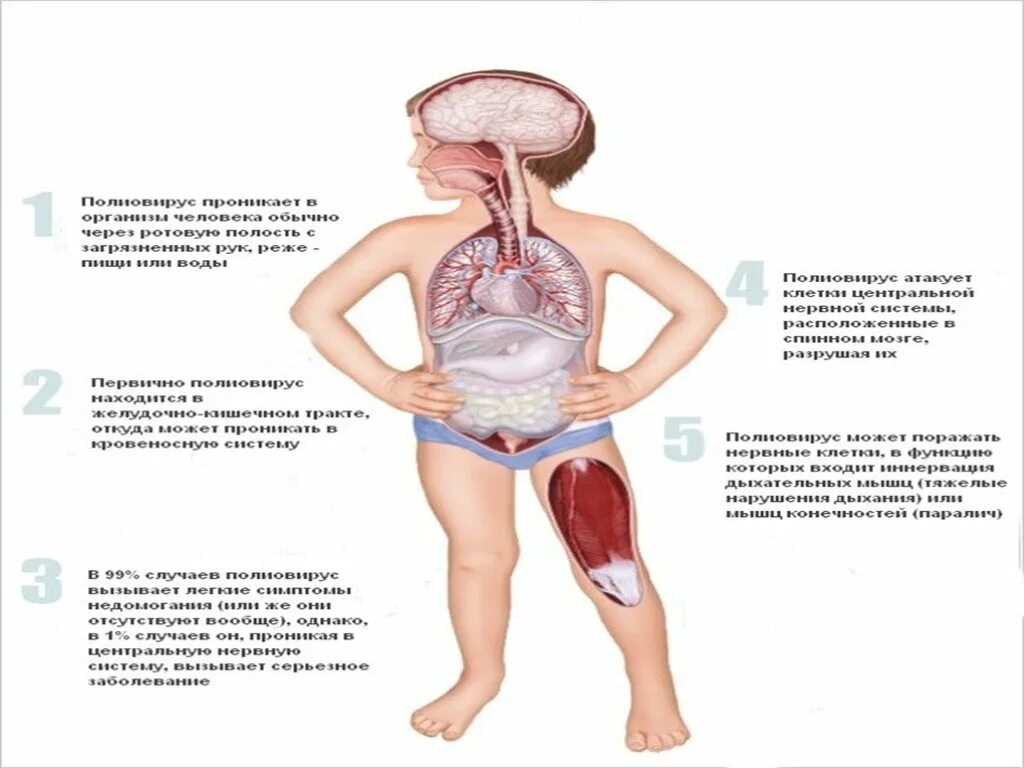 Клинические симптомы полиомиелита. Полиомиелит проявления болезни. Вирус полиомиелита пути передачи. Полиомиелит симптомы у детей. Полиэмилит что за болезнь.
