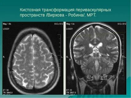Мрт расширение