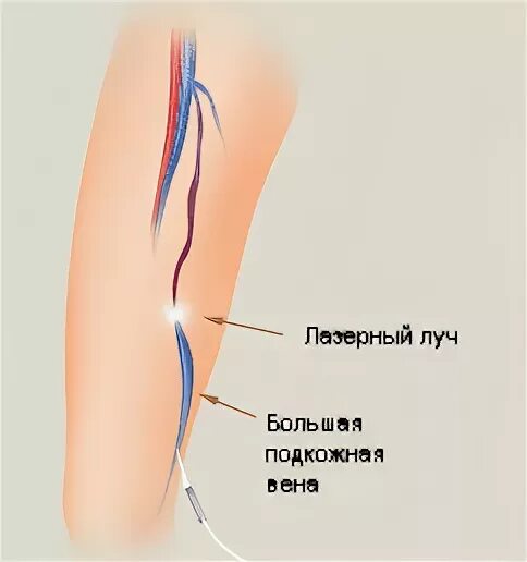 Лазерная подкожная коагуляция