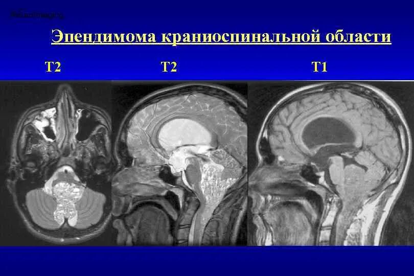 Эпендимома желудочка головного гистология. Эпендимома 4 желудочка. Эпендимома 4 желудочка головного мозга мрт. Эпендимома головного мозга кт. Эпендимома 4 желудочка.