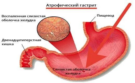 Атрофия слизистая оболочка желудка. Атрофия слизистой желудка. Признаки атрофией слизистой оболочки