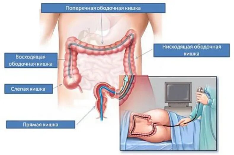 Как обследовать кишечник. Колоноскопия схема проведения. колоноскопия толстого кишечника. колоноскопия прямой и толстой кишки. колоноскопия отделы кишечника.
