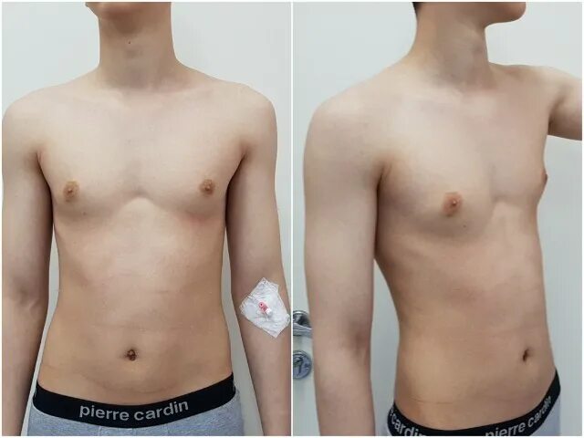 Гинекомастия пубертат. Сосок в подростковом возрасте. Гинекомастия у подростков 14 лет. Гинекомастия у подростка. Молочные железы подростка.