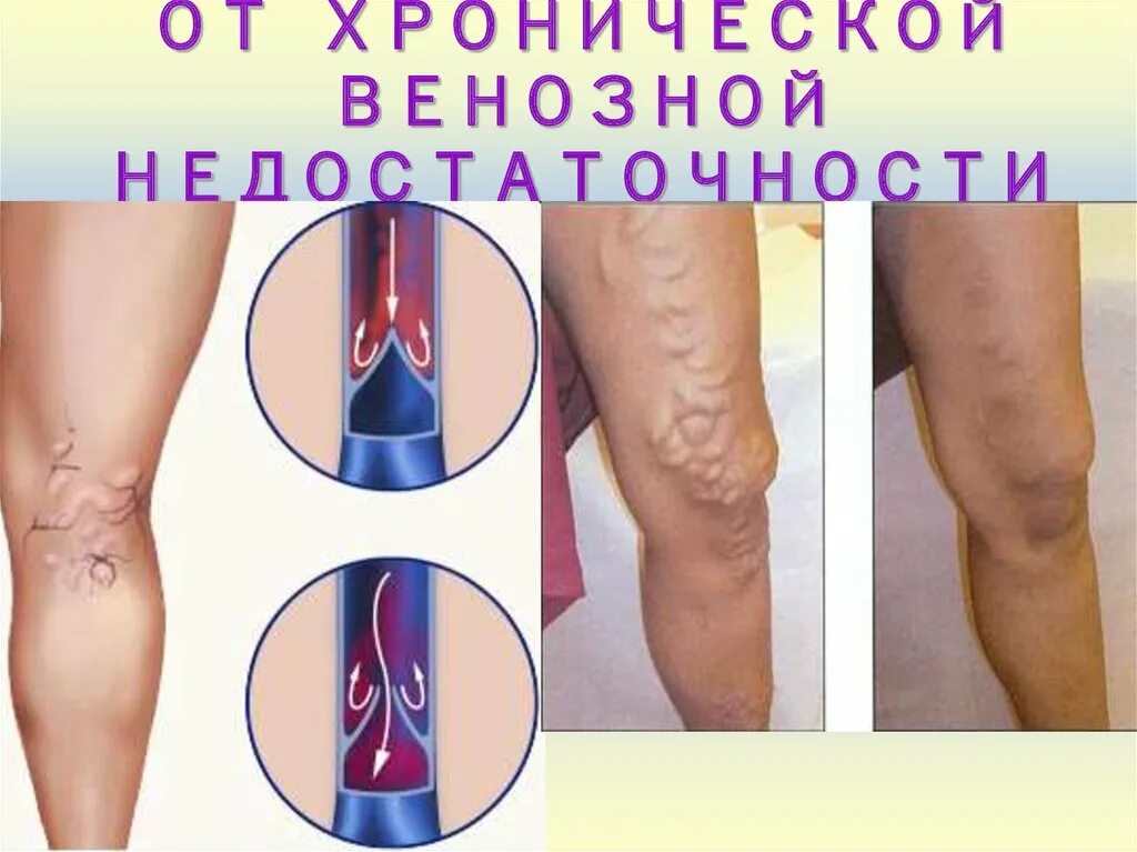 Удаление тромба лазером
