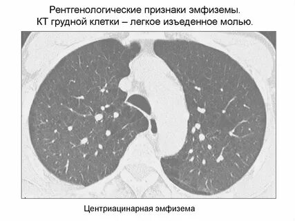 Признаки эмфиземы