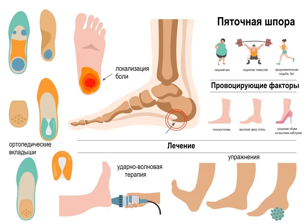 Как лечить шпоры пяточной стопы: найдено 87 изображений