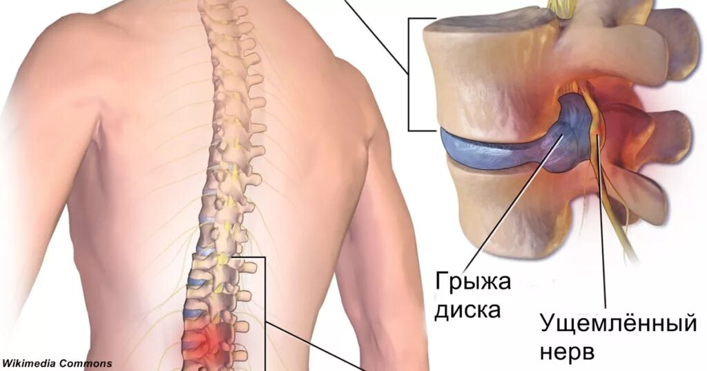 Защемление нерва в спине поясница. Протрузии l1-l4. Диски l5-s1 в позвоночнике. Протрузия l3-l4. Протрузия l5-s1.