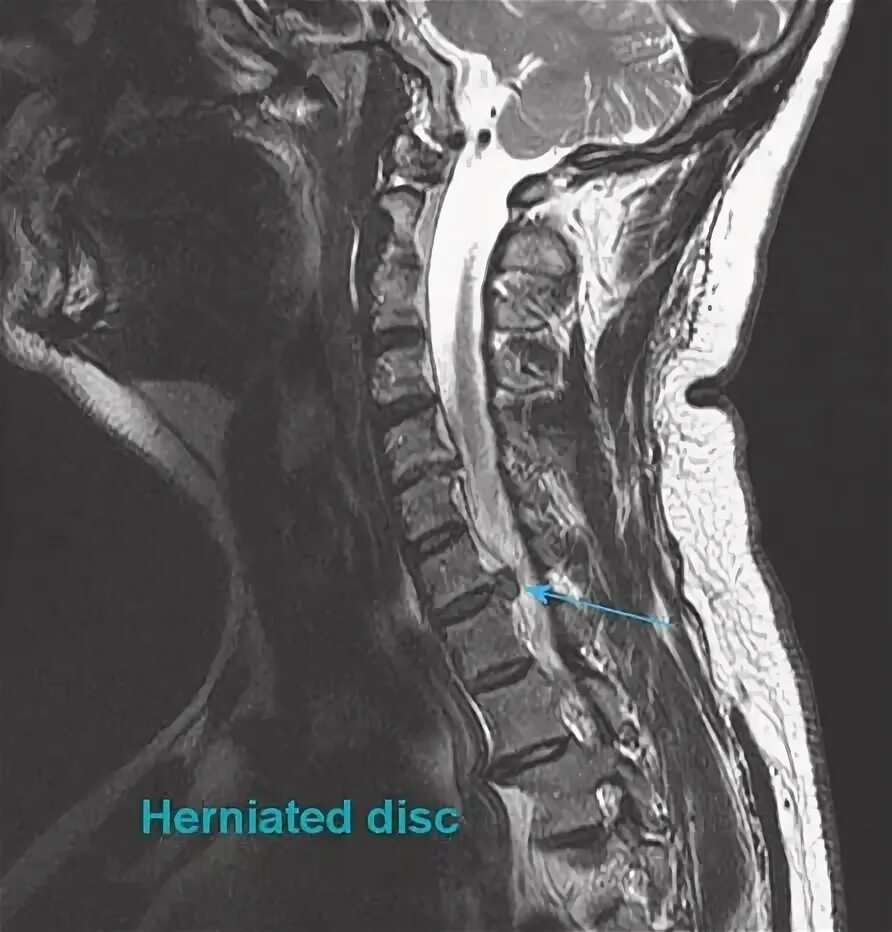 Межпозвонковая грыжа на шее. Межпозвонковая грыжа шейного отдела. Грыжа шейного отдела втижен.