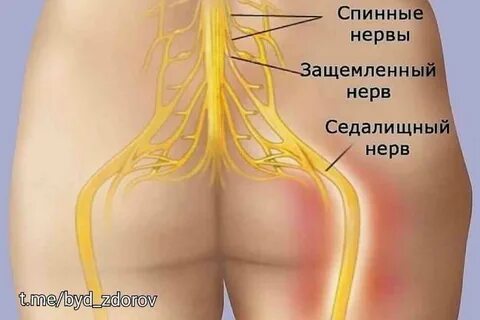 Болит поясница справа отдает в ягодицу