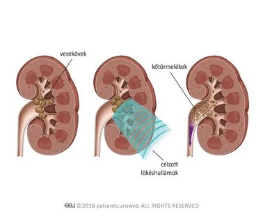Nagyobb vesekövek kezelésére szolgáló eljárások - PI HU