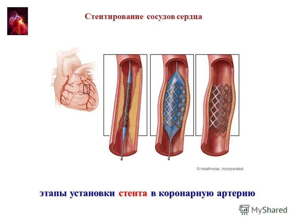 Баллонная коронарная ангиопластика. ТРАНСЛЮМИНАЛЬНАЯ ангиопластика. Эндовенозная ТРАНСЛЮМИНАЛЬНАЯ ангиопластика. Чрескожная ТРАНСЛЮМИНАЛЬНАЯ коронарная ангиопластика. ТРАНСЛЮМИНАЛЬНАЯ баллонная ангиопластика аорты.