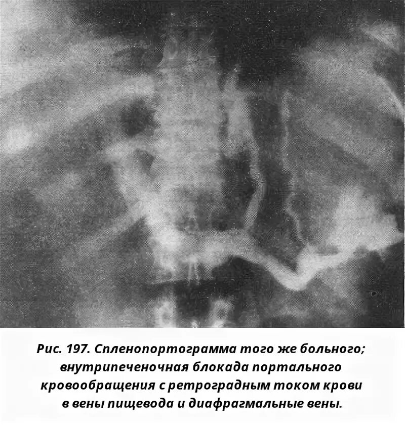 Портальная гипертензия у детей. Портальная гипертензия у детей клиника.