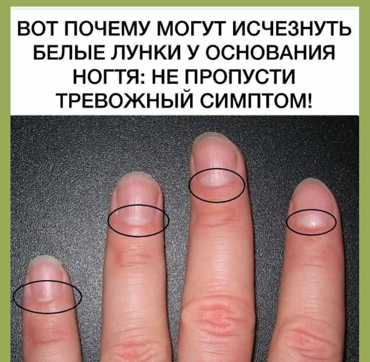 Что значит ногтях. Лунки на ногтях. продольные полосы на ногтях.