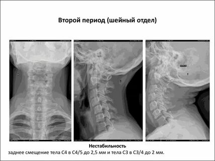 Сместились шейные позвонки