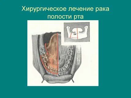 Рак полости рта первые признаки
