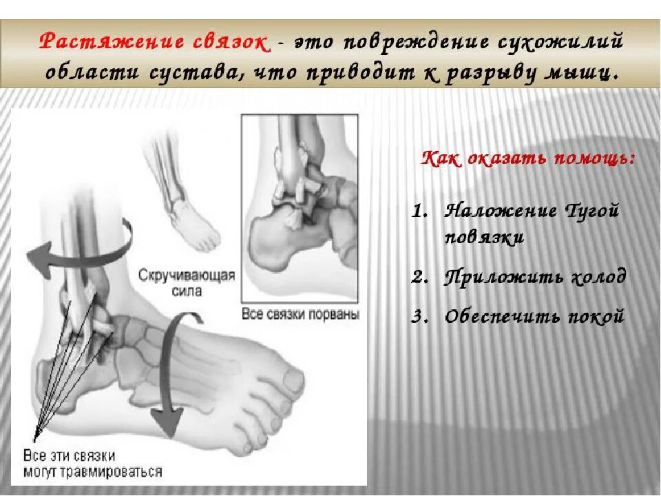 Разрыв связок врач. Растяжения, повреждения связок.. Симптомы растяжения и разрыва связок.
