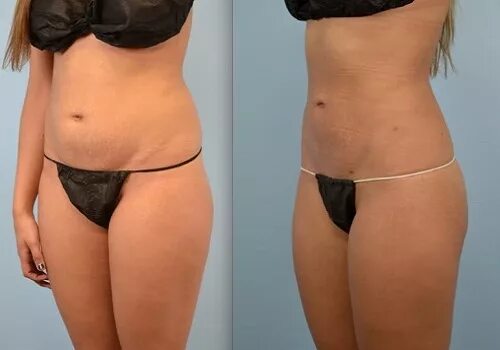 липосакция живота и боков отзывы. липосакция живота и боков отзывы. абдоминопластика парыгин. липосакция липоскульптурирование. липосакция живота и боков отзывы.