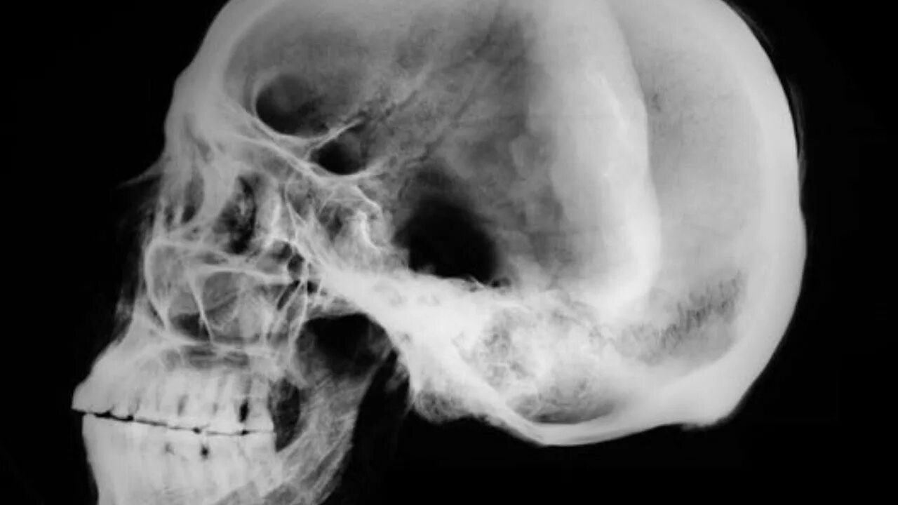 Черепная аномалия. Рентгенографическое исследование черепа. Рентгеновский снимок черепа.