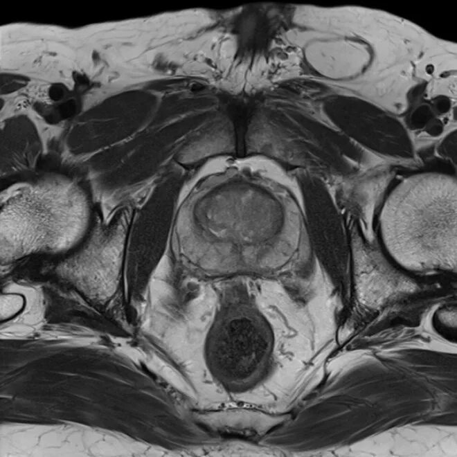 Кт органов таза у мужчин. Мрт ОМТ малого таза. Карцинома мрт предстательной железы. Анатомия предстательной железы мрт. Мрт предстательной железы с контрастированием.