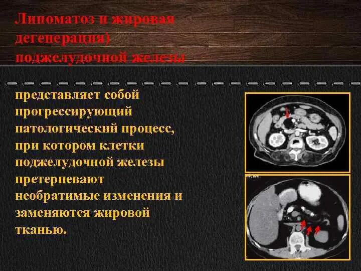 Инволюция поджелудочной железы кт. Дистрофия поджелудочной железы кт. Жировая дистрофия поджелудочной железы кт. Жировая дегенерация поджелудочной железы на кт. Очаговые изменения поджелудочной