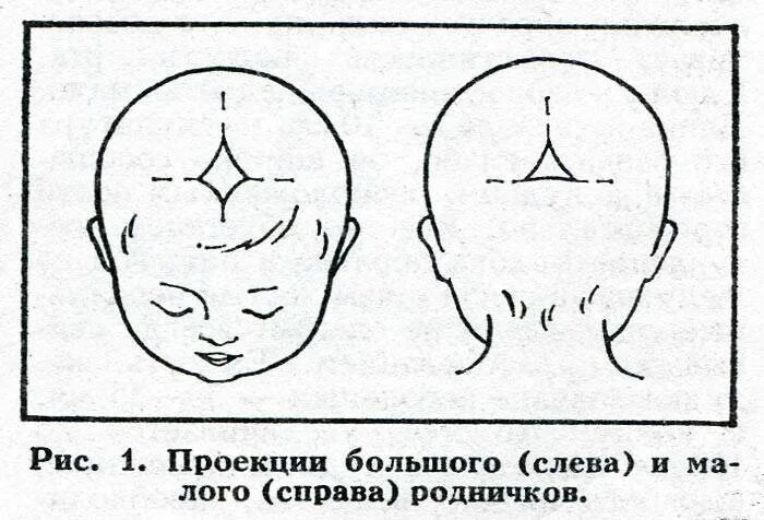 Родничок норма. Большой и малый Родничок у новорожденного. Форма малого родничка у новорожденного. Родничок и темечко у новорожденных. Норма темечки у младенцев.