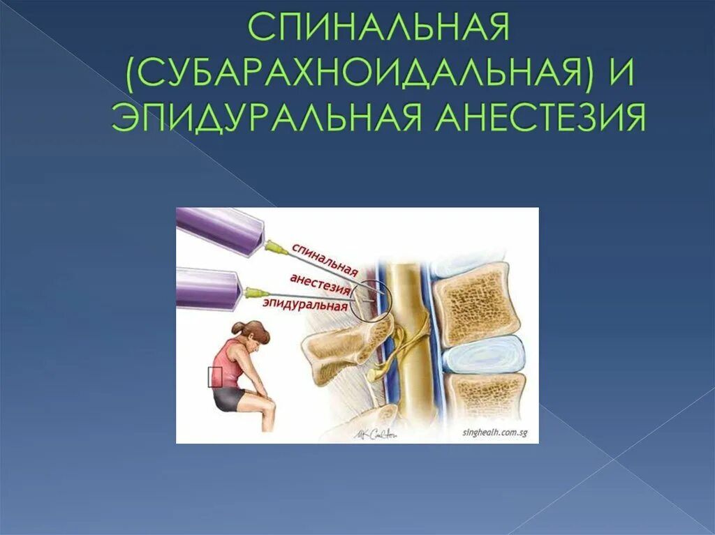 Эпидуральная спинная. Эпидуральная и субарахноидальная анестезия. Спинномозговая и эпидуральная анестезия. Спинномозговая анестезия и эпидуральная анестезия.