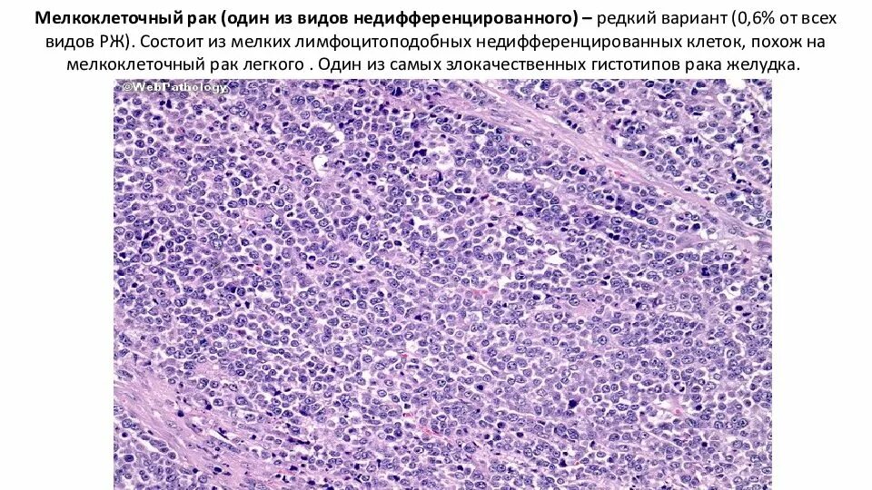 Недифференцированная карцинома. Мелкоклеточная карцинома. Недифференцированные опухоли легких. Мелкоклеточная карцинома легкого гистология. Лечение мелкоклеточного рака