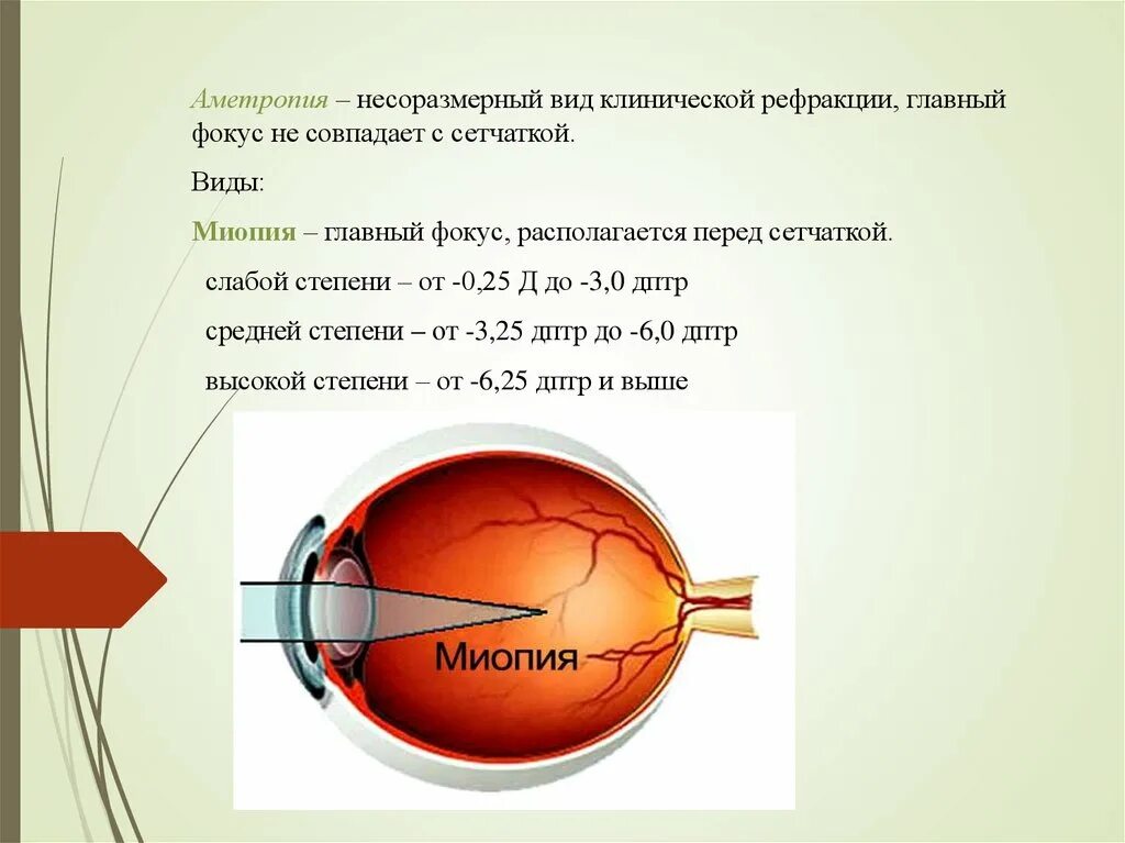 Миопия средней степени астигматизм миопический. Миопия средней степени при дальнозоркости. Миопия 1 степени обоих глаз. Миопия слабой степени.