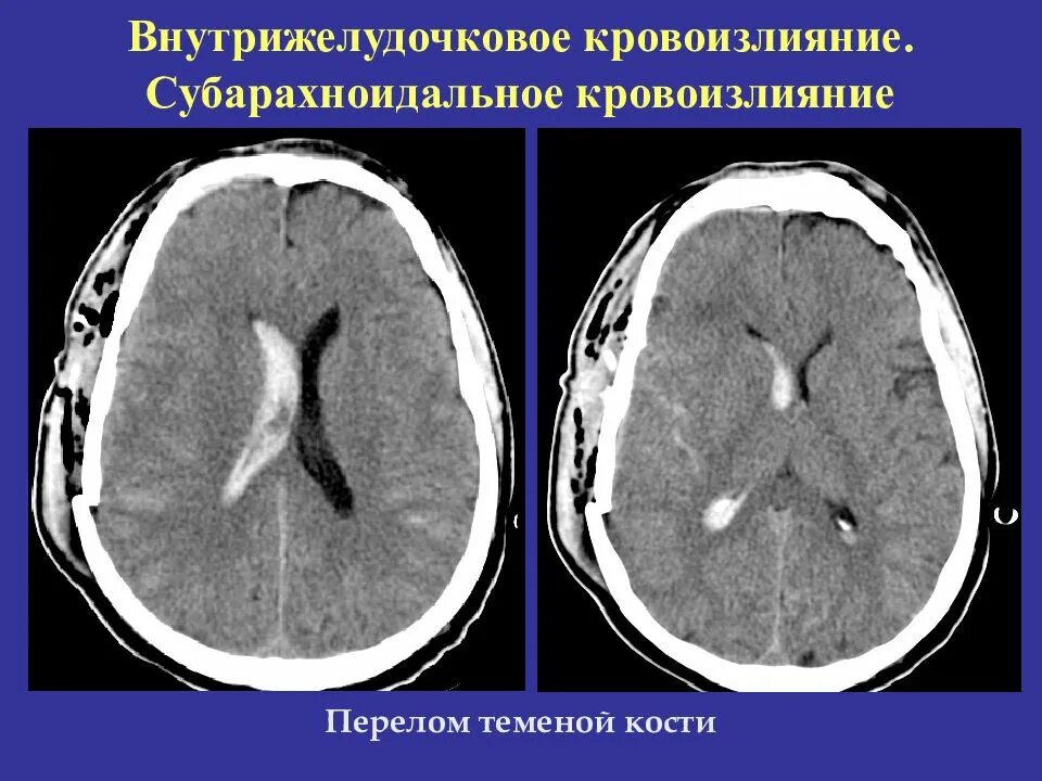 Внутрижелудочковое кровоизлияние. Субарахноидальное кровоизлияние головного мозга на кт. внутрижелудочковые кровоизлияния степени. паренхиматозно-субарахноидальное кровоизлияние кт. внутрижелудочковое кровоизлияние кт.