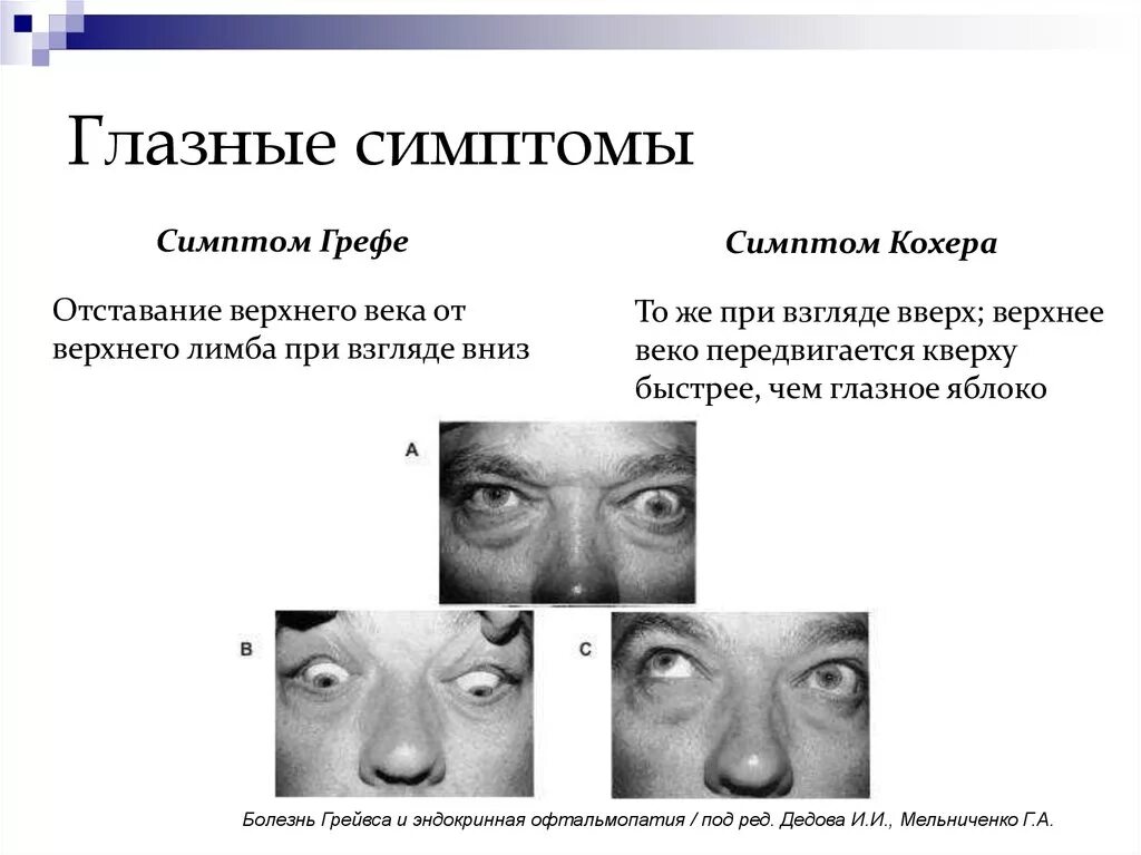 Экзофтальм наблюдается при. Эндокринная офтальмопатия клинические рекомендации 2020. Симптомы Грефе Мебиуса Штельвага. Эндокринная офтальмопатия симптом Грефе. Симптомы Мебиуса, Грефе, кохера, Краузе.