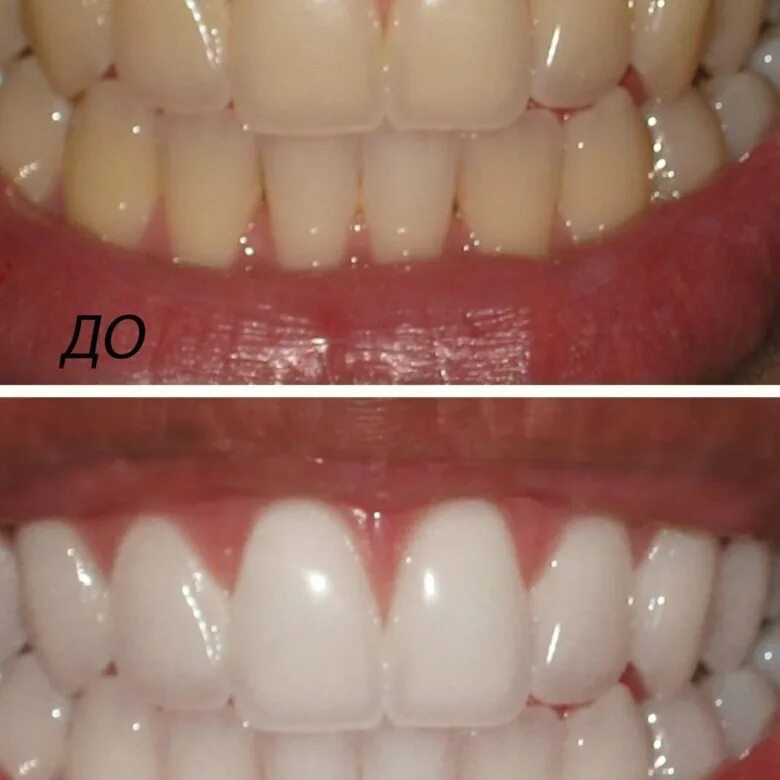 Отбеливание зубов. Лазерное отбеливание зубов. Отбеливание зубов до и после. Зубы до и после отбеливания. Отбеливание зубов отзывы цены