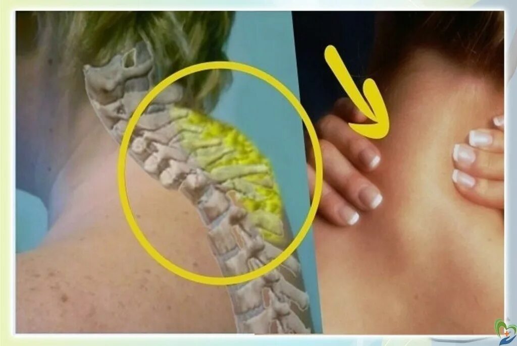 Лазерная липосакция вдовьего горба. Почему появляется холка. Почему появляется холка. Липосакция вдовьего горба. Почему появляется холка.