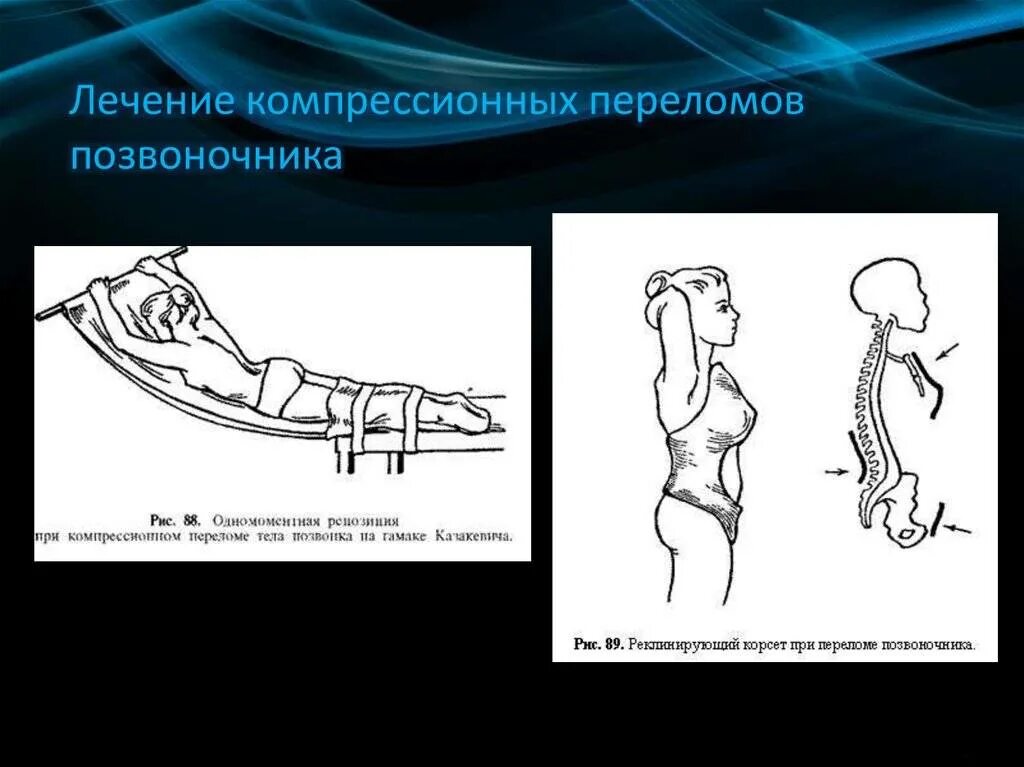 Перелом позвоночника у ребенка последствия. Компрессионный перелом позвоночника вытяжение. Компрессионный перелом позвоночника скелетное вытяжение. Компрессионный перелом 6 позвонка. Гамак при компрессионном переломе позвоночника.